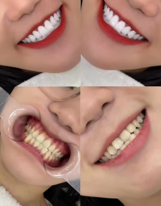 Răng Sứ Lava 3M
SAY BYE to dark gums & yellow-stained teeth,
SAY HI to a crystal-white, healthy smile ✨
At Rose Dental Clinic, a beautiful smile means
Aesthetics + Health.
💄 Aesthetics:
Custom-designed tooth shapes, naturally translucent ceramic shades, perfectly balanced to enhance your facial harmony and confidence.
🦷 Health:
Maximum preservation of natural teeth, strong and durable for comfortable everyday chewing.
👉 Elevate your beauty the refined way, ladies 🦷✨#dentist #venners #smiles #dentalveneers