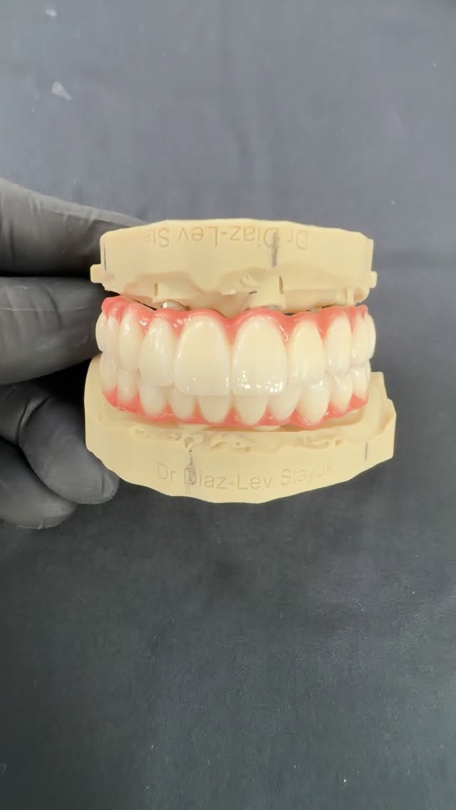 Caso bi maxilar de prótesis híbrida sobre implantes dentales. #esteticadental #cali #sonrisa #nakardentalcenter #implants