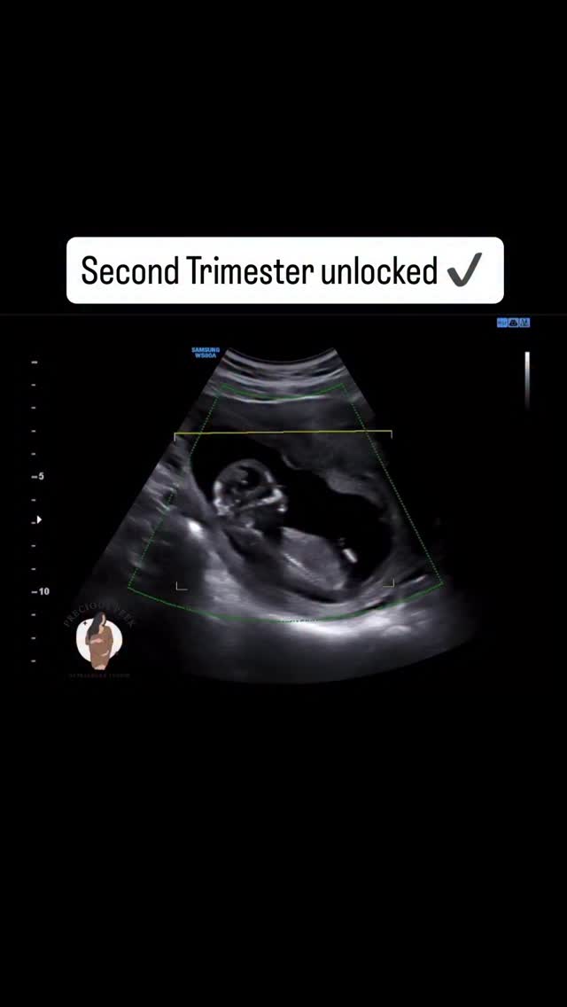 When you hit the second trimester and baby says:
“WE MADE IT” 🕺 ❤️
#pregnancy #ultrasound #pregnant #genderreveal #secondtrimester