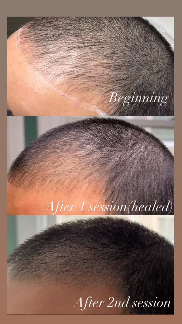 This is the power of SMP 💪
FRAMED offers affordable scalp micro pigmentation services to the San Mateo peninsula! We specialize in brining back natural hair density so you don’t have to worry about the effects of hair loss. This solution requires zero downtime, no travel, and very little pain.
Ready to learn more? Send us a DM