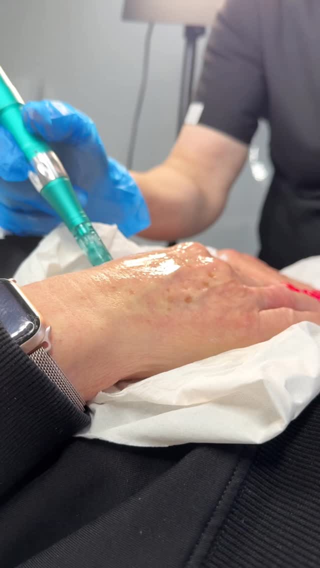 Your face isn’t the giveaway… your hands are.
Hands age faster than the face — thinner skin, fewer oil glands, constant UV, chemicals, and washing.
That’s why wrinkles, crepiness, pigmentation, and visible veins show up early.
And the worst part?
They’re always on show.
Phones. Steering wheels. Jewellery. Hand gestures. Social media.
Even with a flawless face… aged hands quietly reveal your age.
True rejuvenation doesn’t stop at the jawline.
It stops when everything matches.
📩 DM HANDS to book your consultation.
#aestheticclinicliverpool #antiaging #liverpoolaesthetics #antiaging #aesthetictrainingliverpool