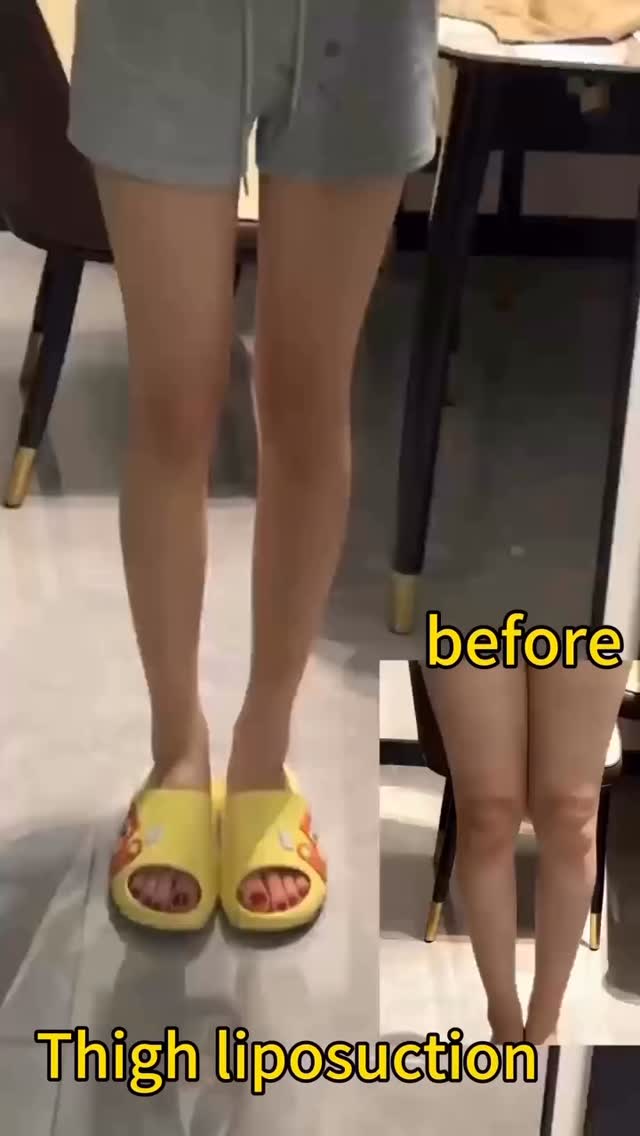 Full thigh liposuction with R&R beauty Aesthetic.
#medicaltourism #plasticsurgery #fatremoval #lipo #cosmeticsurgery