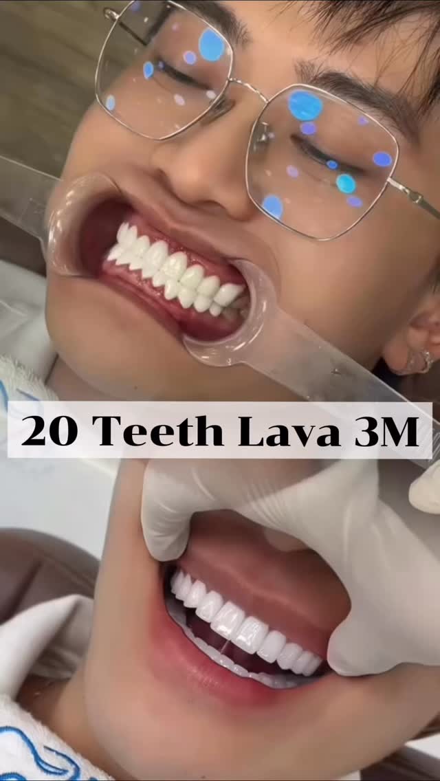 ADD ONE SMILE – SHINE BRIGHT THIS TET! ✨
🌸 A journey to reclaim a healthy, radiant smile with DR Smile
After choosing low-quality dental crowns at another clinic, A had to face many worries:
💢 Teeth discoloration and yellowing
💢 Gum inflammation and dark gum lines
💢 And most of all, the fear of pain when removing old crowns to redo her smile
😔 She hesitated for a long time… until she finally decided to trust Rose.
💖 And the surprise?
It was completely painless – stress-free – and much gentler than she ever imagined.
The treatment was carried out with great care and precision, allowing her to quickly feel comfortable, safe, and at ease.
👉 By choosing 20 premium Lava™ 3M ceramic crowns, she completely transformed her smile:
• ✨ Naturally bright, crystal-clear tooth color
• ✨ Healthy, pink gum lines
• ✨ Harmonious, youthful tooth shape
• ✨ Confident, radiant smiles just in time for Tet
🎉 A new smile – a new look – a truly complete Tet season.
⸻
🏥 R&R Beauty Clinic
🌍 Medical Tourism Services in Vietnam
📍 Clinic address: 10A Trúc Đường, An Khánh Ward, District 2, Thu Duc City, Ho Chi Minh City
#teethvenners #dentalveneers #dentalcorw #medicaltourism