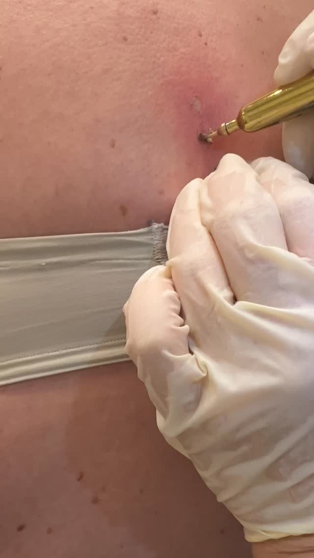 ✨ Alterswarzen, Pigmentflecken & Narben? ✨
Entfernung & Reduktion sanft mit Plasma möglich!
Du störst dich an
✔ Alterswarzen
✔ Pigmentflecken
✔ kleinen Hautunregelmäßigkeiten
✔ Narben (z. B. Akne- oder OP-Narben)?
👉 Mit moderner Plasma-Technologie können diese Hautveränderungen gezielt entfernt oder sichtbar reduziert werden – ohne OP, ohne Schnitte, präzise & hautschonend.
💡 Vorteile der Plasma-Behandlung:
✔ punktgenaue Entfernung
✔ minimale Hautbelastung
✔ schnelle Abheilung
✔ natürliches Hautbild
💶 Schon ab 20 €
📍 Individuelle Beratung vor jeder Behandlung
Plasma Schulungen ebenfalls möglich.
📩 Schreib mir eine DM oder sichere dir direkt deinen Termin –
für eine glattere, ebenmäßigere Haut ✨
#plasmapen #pigmentflecken #narben
Kosmetikstudio, BeautyBehandlung, Hautpflege, PlasmaPen