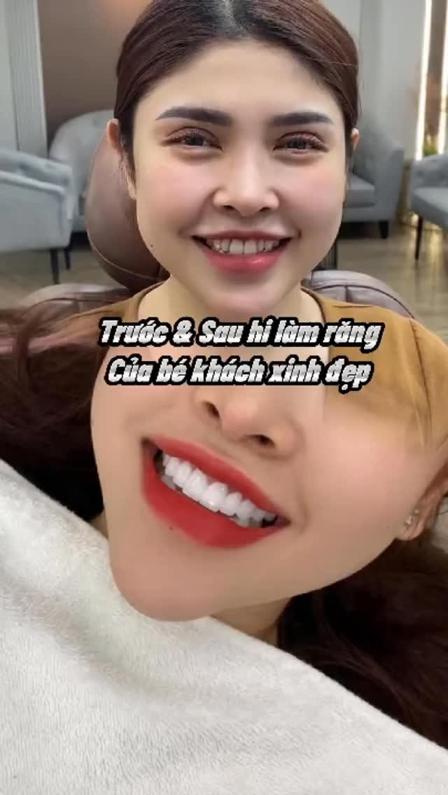 20 Teeth Lava 3M – Why choose Lava 3M?
Lava 3M is considered one of the premium zirconia crown materials in modern cosmetic dentistry. It is often chosen for full-mouth restorations because it balances strength, aesthetics, and long-term safety.
Main reasons to choose Lava 3M
1️⃣ Natural translucency (very aesthetic)
• Lava zirconia has a multi-layered structure.
• The color transitions naturally from the neck to the edge of the tooth.
• Result: bright, translucent, and natural-looking smile—not chalky or opaque.
2️⃣ High strength and durability
• Made from high-quality zirconia.
• Very strong and resistant to cracking or chipping.
• Suitable for full set of teeth (20–28 units), including back teeth.
#lava3mdental #venners #dental_clinic