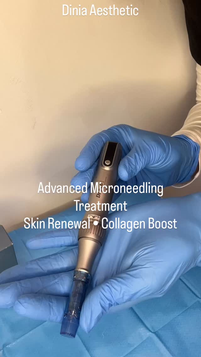 🚨 50% OFF Microneedling – Ends February 28
This is your sign to start your skin transformation.
Smooth texture. Fewer scars. Boosted collagen. Real results.
Don’t wait until it’s gone.
📩 DM “Dinia50” to book now
Limited appointments available.
#DiniaAesthetic #MicroneedlingSpecial #SkinTransformation #GlowUp #LimitedOffer