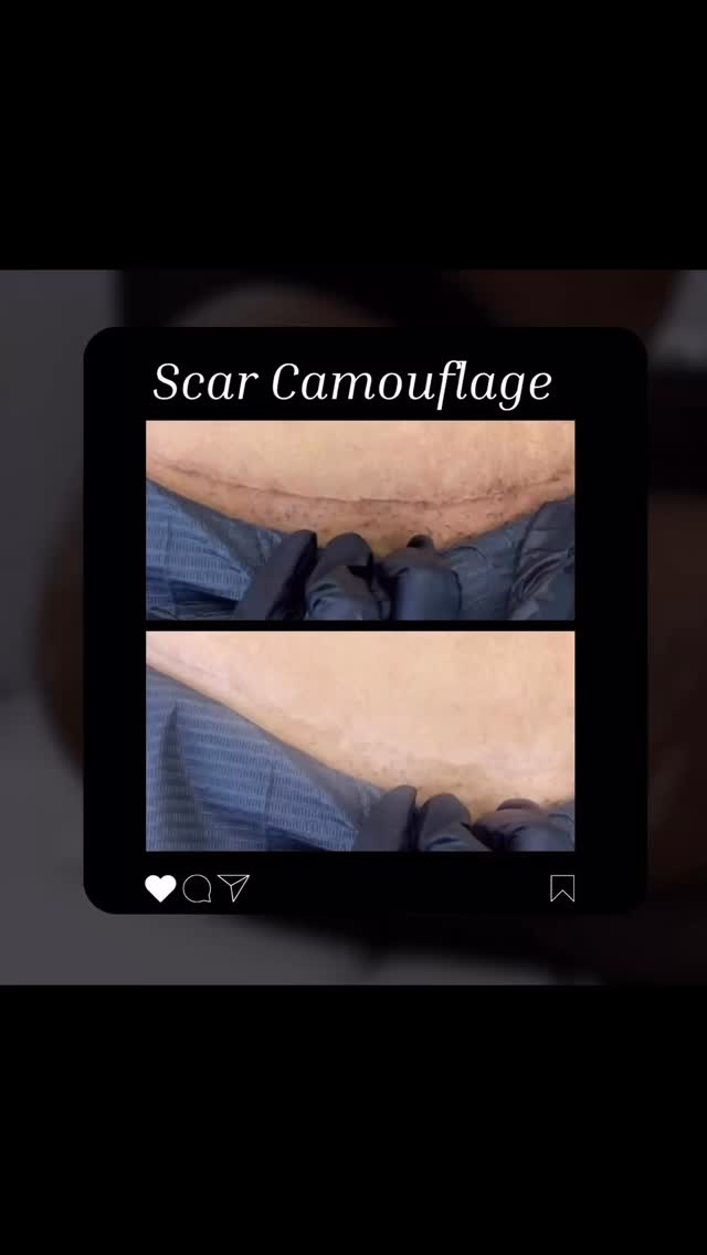 Medical Tattooing can be restorative and confident boosting. Our skill in color theory, understanding the science behind ink formulas and artistic approaches to color matching skin tones is what sets us apart. The end results are optimal and natural appearance upon 3-5 sessions. Trusting the process is key in the camouflaging journey.
Book your consultation today!
If you’re interested in learning this technique be sure to enroll in our next Scar Camouflage Training.
BEATANDBLADE.COM
(832) 377-5677
📍Houston, TX
info@beatandblade.com
#beforeandafter #tummytuck #liposuction #transformation #viral