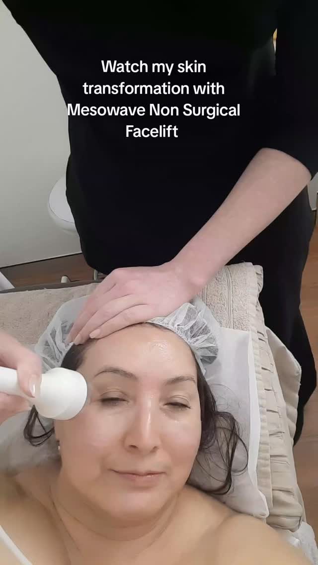 Did you know ?
As we grow older our skin firmness & texture changes due to loosing collagen production and other important nutrients in our body ( a post for another day)
Our Mesowave Non Surgical Facelifts, a combination of Laser, Microcurrent & Ultrasound? are specifically designed to help infused special Vitamins /serums into the deeper Dermis.
Together, they generate tiny little movements that trick the facial muscles & boosting collagen and elastin production at the same time 🥰
Watch the eye area muscles contracting
(like a gym workout for your facial muscles) during the process👀
Learn more about Mesowave by reading our blog on website!
@beautyblitzonqueen
.
.
#skincaretips
#nonsurgicalfacials
#antiageing
#advancedfacials
#skintherapistlogan