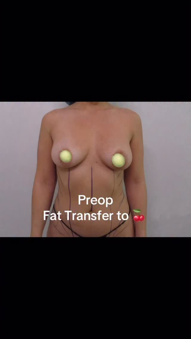 FAT TRANSFER TO THE BREAST – A NATURAL BREAST ENHANCEMENT OPTION
Fat transfer to the breast is a procedure that uses your own body fat (usually taken from the tummy, waist, thighs, or back) and injects it into the breast to increase volume and improve shape in a natural way.
This procedure is often combined with liposuction, allowing you to slim unwanted areas while using that fat to enhance the breast.
⸻
How much of the fat will remain?
After about 6–8 weeks, the body stabilizes and typically 40–60% of the transferred fat will remain long term.
That means:
• The increase in size is natural and subtle
• It is not ideal for patients who want a dramatic size increase
⸻
Who is a good candidate?
Fat transfer is suitable for:
• Patients who want to increase about one cup size
• Those who prefer not to use implants
• Naturally shaped breasts that need more fullness
• Patients seeking a soft, natural-looking result
• Those who want body contouring and breast enhancement at the same time
⸻
When are implants a better option?
Breast implants are more suitable if you:
• Want to increase two or more cup sizes
• Desire a fuller upper pole (upper breast)
• Want a more noticeable and long-lasting volume change
⸻
Advantages of fat transfer
✔ Uses your own natural fat
✔ Soft, natural look and feel
✔ Slims other areas of the body
✔ No large surgical scars
Procedure: Fat Transfer to the Breast
Commonly combined with: Liposuction of the tummy, waist, thighs, or back.#fattransfer #bbl #liposuccion