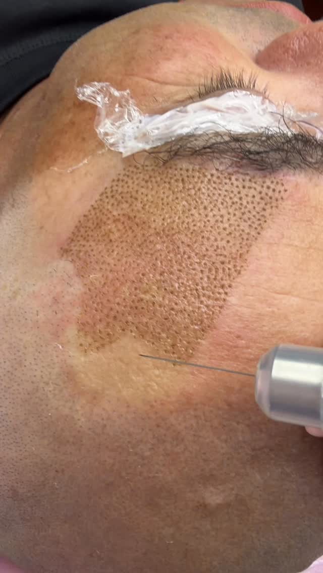 💁♀️ Brow lift transformation for this businessman from New Plymouth 💪
He visits me every couple of months for a full range of treatments — cold plasma for scar repair, hair growth, HIFU, brow work, and today’s focus: skin tightening to lift one side of the brow.
After going through plastic surgery, he trusted me to handle all the finishing touches and aftercare to complete his look and boost his confidence. He even joked that he wished I were a plastic surgeon 🤣🤣
Honestly… I wish too — but maybe it’s a little late for that!
I did ask my son to become a plastic surgeon one day making lots of money, but he said if he ever becomes a doctor, he’d rather save lives than make people more beautiful after surgery ☹️❤️! Mother 🤐🤐
Confidence looks good on everyone ✨
#nonsurgicalfacelift #eyebrowlift #plasmafibroblast #judynguyen #eyelidlifting