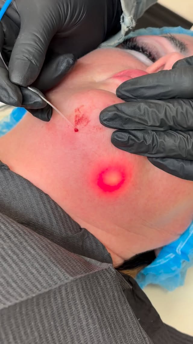 Double chin fat reduction. Available at @urbanangelaesthetics 💓 #endolaser #endolift #endoliftingláser #fatreduction #endoliftderby