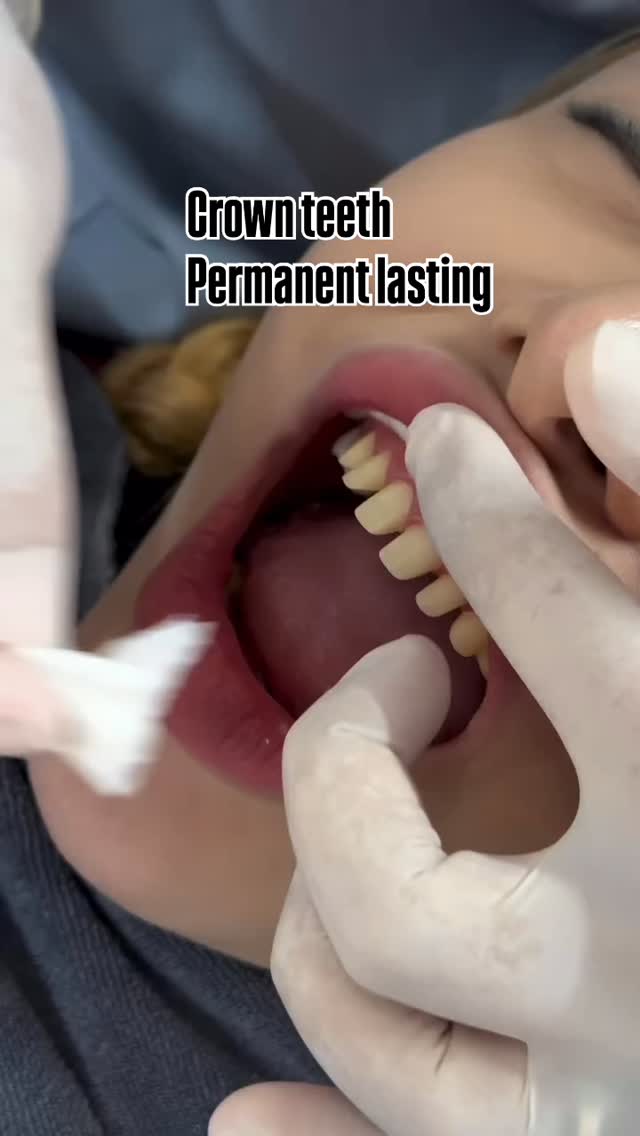 What Is the Process of Getting a Dental Crown?
🦷 Step 1: Tooth Preparation
• The dentist reshapes (files down) the natural tooth
• Removes any decay (if present)
• Creates enough space for the crown to fit properly
📸 Step 2: Taking Impressions
• Traditional impression or digital 3D scan is taken
• The scan/impression is sent to the dental lab to fabricate the crown
🛡 Step 3: Temporary Crown Placement
• A temporary crown is placed to protect the prepared tooth
• Usually worn for about 3–7 days
✨ Step 4: Final Crown Placement
• The dentist checks the shape and color
• The crown is permanently fixed using special dental cement
The entire procedure is done under local anesthesia, so it is generally painless.
#crownteeth #medicaltourism #dental #venners