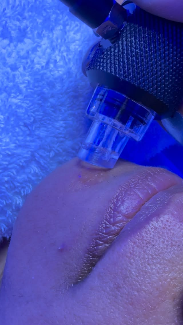 Up close + Personal💦✨✨
The Hydrofacial is doing two things at once—continuous water flow delivers chemical peels and infuses hydrating, corrective serums into the skin while gentle suction lifts away dead skin cells, oil, and pore congestion.
The result? Instantly smoother texture, clearer pores, deeper hydration, and a visible glow with no downtime. Hydrofacials help improve acne, dullness, fine lines, and dehydration while supporting long-term skin health.
💧Healthy skin looks better. Book your Hydrofacial glow at Luminance Beauty & Body
#hydrafacial #atlantaesthetician atlantaspa #atlfacials #atlesthetician