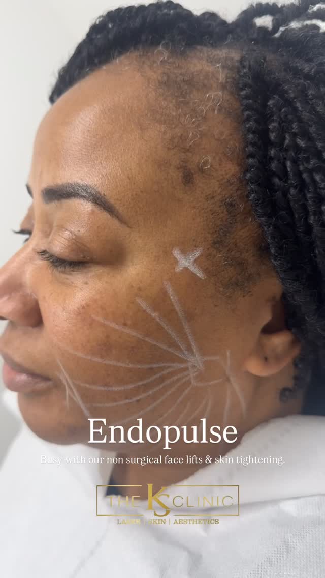 ENDOPULSE / ENDOLIFT is a minimally invasive, non-surgical laser treatment used for skin tightening, fat reduction, and body contouring.
It uses diode laser technology delivered via micro-optical fibers beneath the skin to stimulate collagen and melt fat, primarily targeting the face, neck, and body.
The procedure is performed under local anesthesia with minimal downtime, often used as an alternative to traditional lifts.
Key details about Endopulse:
Target Areas: Treats the neck, lower face, jawline, chin, upper/lower eyes, arms, and stomach.
Procedure: A thin, hair-like fiber is inserted beneath the skin, delivering laser energy to tighten tissue and reduce localized fat deposits.
Benefits: Promotes collagen production, improves skin elasticity, and contours areas affected by aging.
Recovery: The procedure typically takes 30-60 minutes, with side effects limited to mild swelling or bruising that resolves in a few days.
Treatments start for £1200. Klarna available.
Results last up to 2-3 years.
Book your treatment / consultation today.
#endolift #endoliftingláser #endosculpt #skintightening #skinlifting