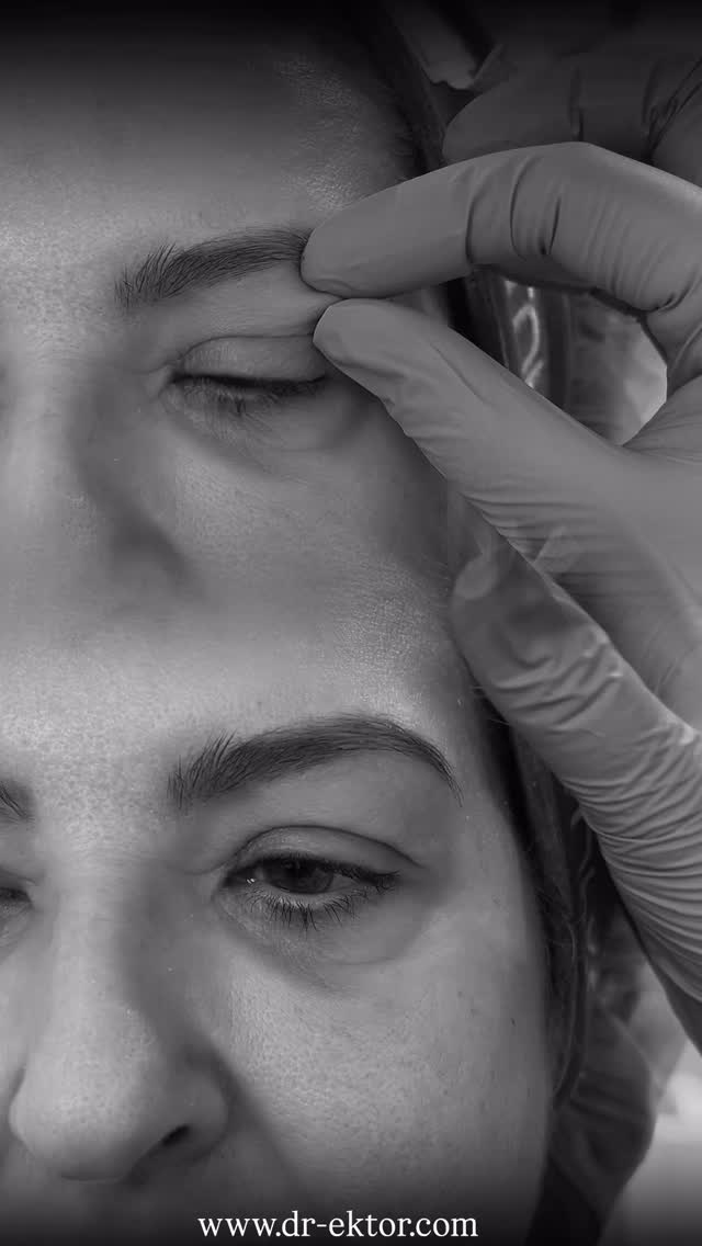 ✨ Real results. ✨
Ξεκούραστο & λαμπερό βλέμμα
μετά από άνω βλεφαροπλαστική & brow lift
Αποτέλεσμα 2 μηνών 👁️
Η ουλή βρίσκεται σε φάση επούλωσης και μπορεί να εμφανίζεται ελαφρώς ερυθρή και ορατή σε αυτό το στάδιο 🧬
Πρόκειται για μέρος της φυσιολογικής διαδικασίας, καθώς το δέρμα συνεχίζει να προσαρμόζεται και να βελτιώνεται με τον χρόνο.
Καθώς η επούλωση προχωρά, η όψη της ουλής μαλακώνει και εξασθενεί ⏳
Το τελικό αποτέλεσμα αξιολογείται στους 6 μήνες, όπου η ουλή δεν θα είναι πλέον ορατή.
✨ Trust the process. Stay tuned for the final result…
Η αλλαγή; ✨
Ένα πρόσωπο πιο φρέσκο, πιο φωτεινό και πιο ξεκούραστο,
χωρίς να φαίνεται «φτιαγμένο».
💉 Εντελώς ανώδυνη διαδικασία με τοπική αναισθησία ή μέθη
⏳ Γρήγορη ανάρρωση, χωρίς πόνο και ελάχιστο ρίσκο
⭐️ Only @dr.ektor
Αν νιώθετε ότι το βλέμμα σας δείχνει κουρασμένο,δεν είναι ποτέ πολύ νωρίς (ή πολύ αργά) για να δείτε ποιες επιλογές έχετε.
📩 Στείλτε μας DM για περισσότερες πληροφορίες ή καλέστε:
📞 +30 210 725 8982 (GR)
📞 +357 96 444 870 (CY)
🌐 www.dr-ektor.com
#RealResults #DrEktor #Blepharoplasty