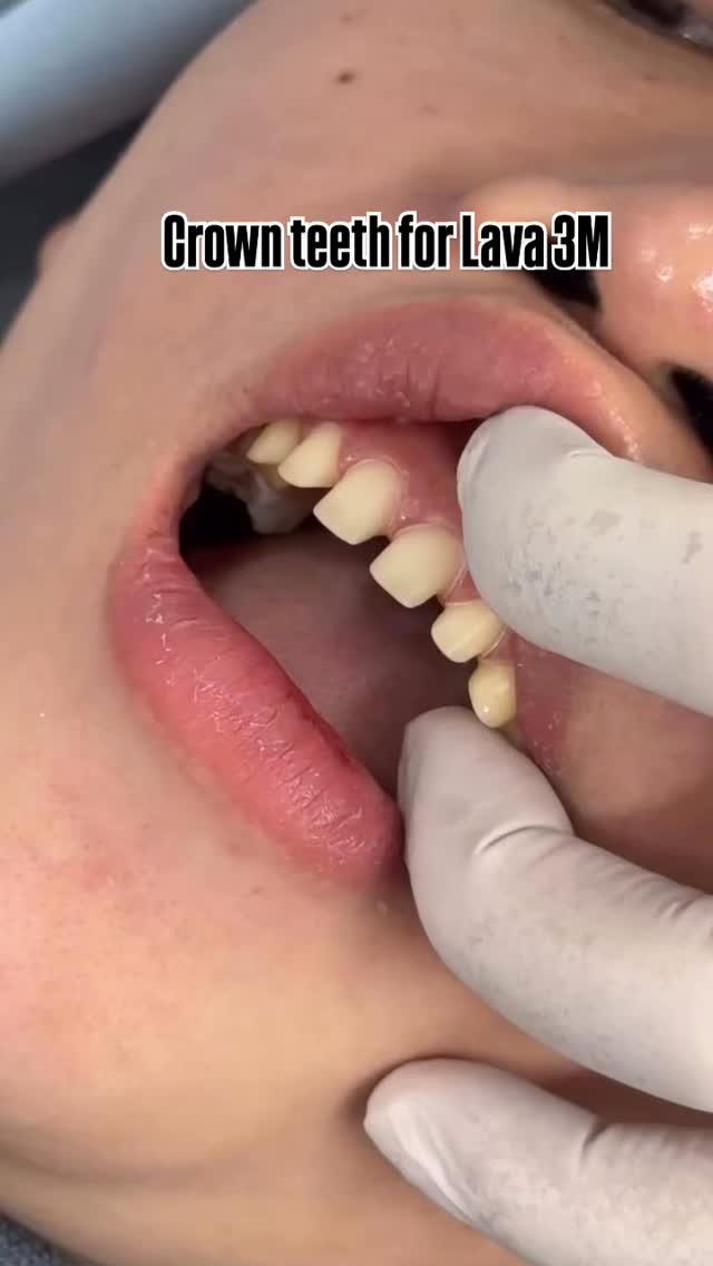 What Is the Process of Getting a Dental Crown?
🦷 Step 1: Tooth Preparation
• The dentist reshapes (files down) the natural tooth
• Removes any decay (if present)
• Creates enough space for the crown to fit properly
📸 Step 2: Taking Impressions
• Traditional impression or digital 3D scan is taken
• The scan/impression is sent to the dental lab to fabricate the crown
🛡 Step 3: Temporary Crown Placement
• A temporary crown is placed to protect the prepared tooth
• Usually worn for about 3–7 days
✨ Step 4: Final Crown Placement
• The dentist checks the shape and color
• The crown is permanently fixed using special dental cement
The entire procedure is done under local anesthesia, so it is generally painless.
#crownteeth #medicaltourism #dental #venners