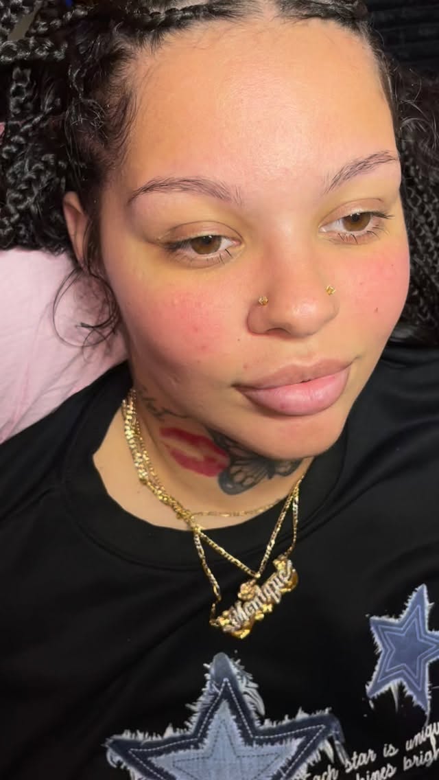 Lips to die for 💋💉. Booking link in bio dm me for any questions or information 💕 #hyaluronpen #lipfiller #lipinjections #facialbalancing #plumplips