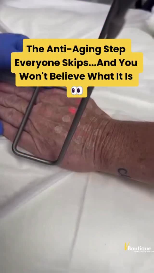 Hands don’t lie 👋✨
They see years of sun, washing, driving, and living… often before the face does.
In this reel I’m using the Fotona laser body handpiece in SMOOTH®️ mode (Er:YAG technology) to gently rejuvenate the hands and the arms 💫
Here’s the science in simple terms 🧬👇
This laser delivers controlled thermal energy that:
• Gently resurfaces the skin (micro-peel effect)
• Stimulates fibroblasts → boosts new collagen + elastin
• Thickens thinning hand skin over time
• Softens crepey texture
• Improves tone + fades sun spots ☀️
• Restores smoother, brighter, healthier-looking hands
And the best part? Minimal downtime 🙌
Expect light dryness + mild peeling that’s easily managed with moisturizers 🧴
✨ Pro tip: My favorite combo is pairing laser with Radiesse in the hands.
Why? Because Radiesse adds subtle volume AND stimulates collagen regeneration, helping:
• camouflage veins + tendons
• improve skin thickness
• enhance long-term skin quality
Laser + biostimulation = the ultimate hand glow-up 💥
Because rejuvenation shouldn’t stop at the face 💅
#handrejuvenation #radiesse #handlaser #skinrejuvenation #fotona