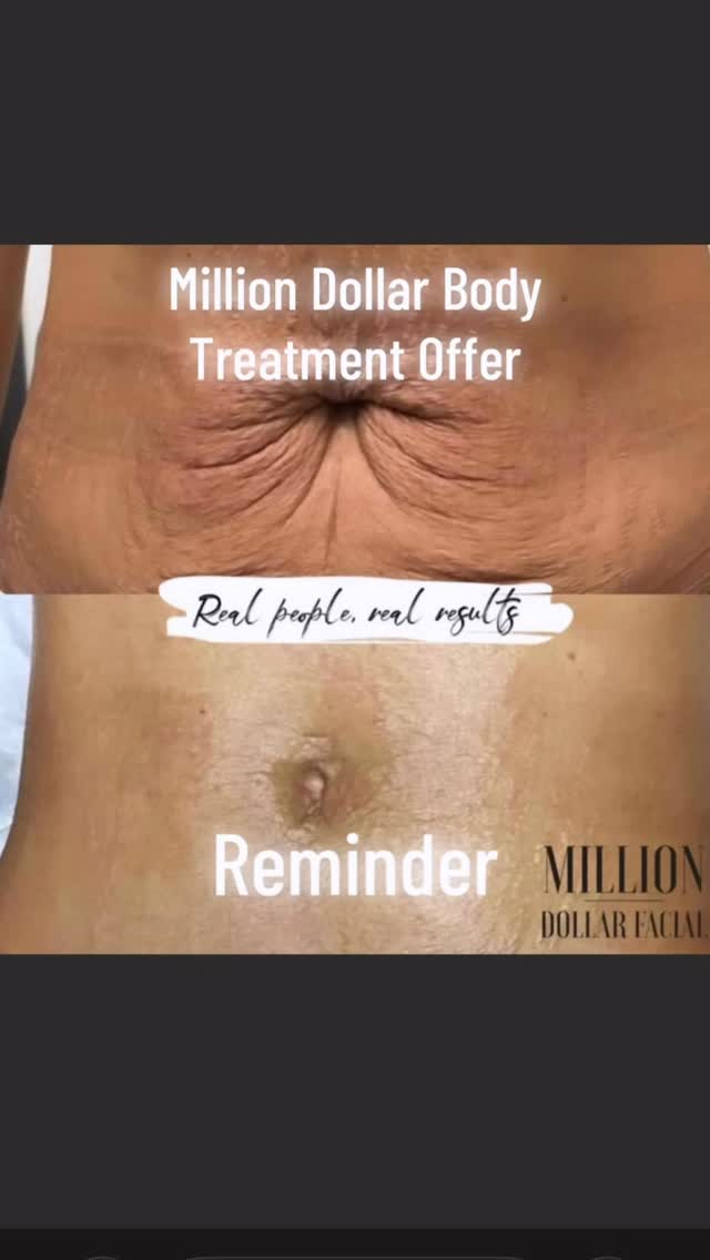 I have a time limited, space limited offer on the Million Dollar Body treatment 💗
Ready to feel firmer, smoother and summer‑ready from head to toe? These results are from fellow Million Dollar Technicians… and now I’m opening up exclusive spaces to build my own Million Dollar Body portfolio.
For Feb bookings only, I’m offering:
🔥 35% off a full Million Dollar Body course
🔥 £52 per treatment instead of £80
🔥 6‑month transformation plan (one treatment per month)
To access this offer, you’ll:
📸 Agree to let me capture and share your progress
📅 Commit to the full 6‑treatment programme
✨ Be suitable for microneedling treatments
🌟 Be ready for a real, visible body glow‑up
Spaces are limited so I can give each client proper attention.
If you want to start your summer body now, drop me a message and I’ll get you booked in.
Offer available for Body treatments only
#skintightening #fyp #selfcare #glowup #cambridgeshire