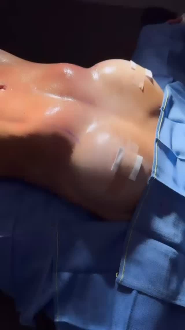 Body liposuction line 11 .
#medicaltourism #rrbeautystudio #lipo #plasticsurgery #lipo