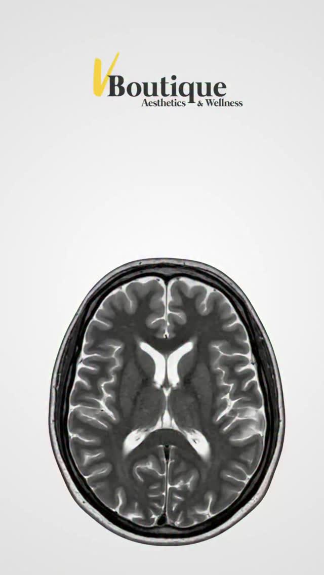 Palm Beach women—if your midlife brain feels glitchy (foggy, unfocused, moody), you’re not failing. Your brain is adapting. Imaging studies show real changes in regions that manage memory, attention, sleep, and emotion. The good news: many shifts stabilize, and daily habits can help your rebound.
At V Boutique Aesthetics, we see anti-aging as whole-person care: consistent sleep + morning light, stress tools, protein-forward nutrition, resistance training/cardio, skin & scalp health, and—when appropriate—thoughtful hormone strategies integrated into your bigger wellness picture. It’s not one product; it’s a plan that fits your brain and body.
📲 Book an antiaging consult (link in bio) or call 561-357-2020.
#modaesthetica #vboutique #aestheticmedicine #antiaging