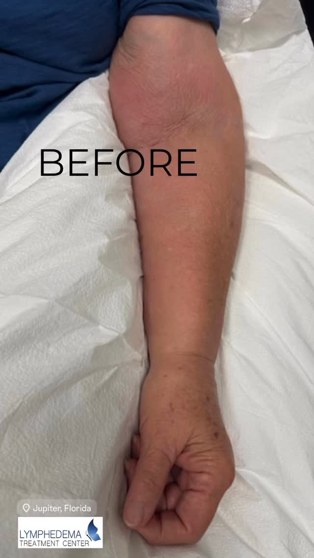 You can get results that make all the difference! Our certified Lymphedema therapists have been specially and thoroughly trained in each component of CDT, including manual lymph drainage, compression therapy, skin care and decongestive exercises. Together we can support, empower and advocate for those impacted by lymphedema to promote optimal health. Visit us at Lymphedema Treatment Center located in Jupiter, FL.
Your first step to relief starts here! Schedule a consultation today and let our expert therapists guide your healing journey.
#BeforeandAfter #LymphedemaRelief #LymphedemaTreatmentCenter #LymphedemaAwareness