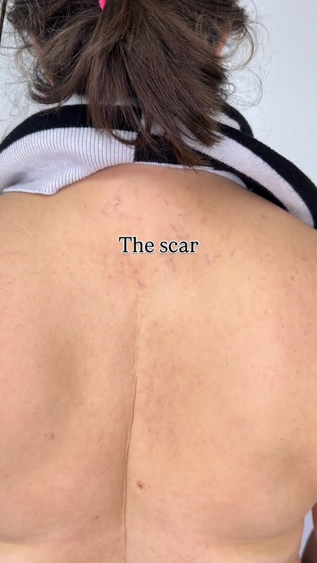 Covered a 15-year-old scoliosis scar ✨
If you notice a little swelling at the end — that’s totally normal! Once the inflammation settles, the scar will soften and blend even more.
There’s something so special about helping someone feel confident in their skin again. I absolutely love doing scar cover-ups. 💛
#ScarCoverUp #TattooTransformation