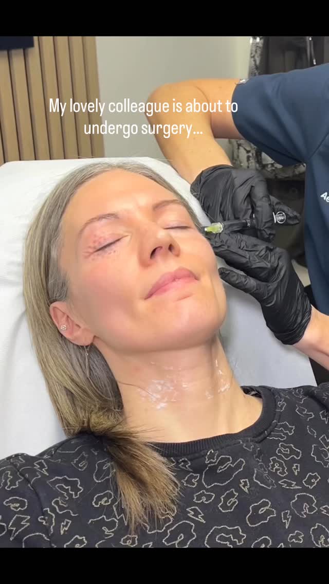 Medicine is at its most beautiful when science meets trust 🤍
Today I had the privilege of treating my dear colleague, preparing her eye and neck skin with polynucleotides ahead of her upcoming left sided neck surgery.
Polynucleotides work on a cellular level to improve skin quality—supporting hydration, elasticity, and tissue regeneration. In delicate areas like the peri-ocular region and neck, this kind of skin conditioning can make a meaningful difference in resilience and recovery.
There’s something especially moving about caring for someone who understands every step of the process and still places their confidence in your hands. A reminder that aesthetics isn’t just about results—it’s about respect for anatomy, timing, and the people who trust us with their faces and futures ✨
#AestheticMedicine #Polynucleotides #SkinQuality #NeckRejuvenation #UnderEyeTreatment DoctorToDoctor TrustInMedicine