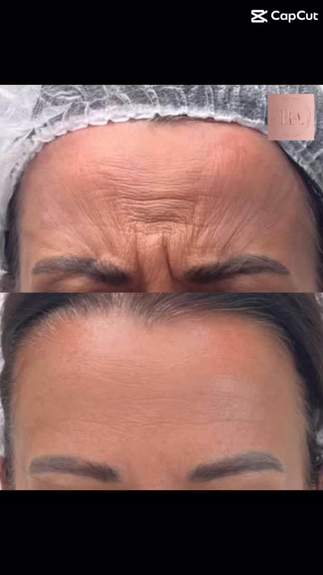 Those “11s” aren’t wrinkles… they’re overachieving muscles 💪😅
Meet the corrugator supercilii (aka the frown muscles).
They pull the brows in and down every time you squint, frown, stress, concentrate… or deal with nonsense.
Over time?
👉 Lines between the brows
👉 A heavier, angrier-looking expression
👉 “I’m not mad” but your face disagrees
✨ Anti-wrinkle treatment works by relaxing these muscles, allowing:
• The skin to smooth
• The brows to gently lift
• The face to look softer + more rested
• You to still look like you — just less permanently unimpressed
Softening the muscle = softening the lines.
Not frozen. Not fake. Just relaxed. 😌
#AntiWrinkleEducation #11sExplained #CorrugatorMuscle #AestheticFacts #NaturalResults SoftNotFrozen FaceMuscleScience