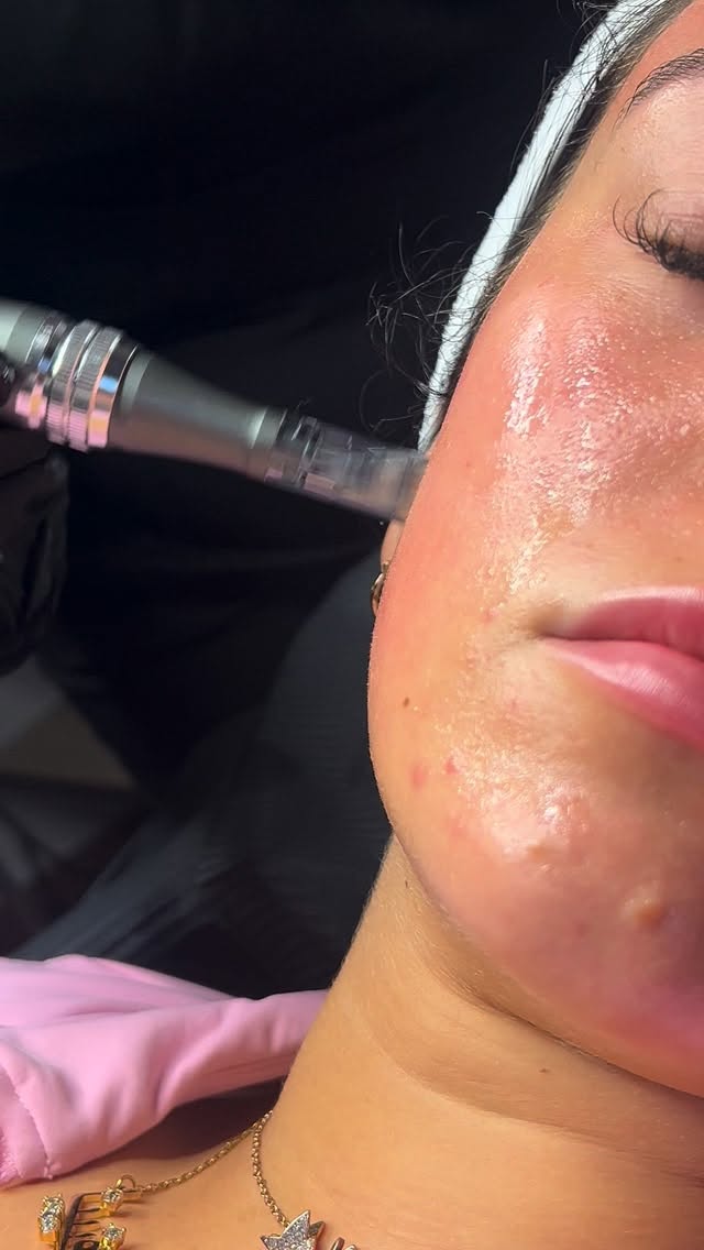 Microneedling is a skin treatment where very fine, sterile needles create tiny, controlled micro-injuries in the skin. It sounds scarier than it is 😅
It triggers your body’s natural healing response, which boosts collagen and elastin production.
Over time, that collagen boost can lead to:
• Smoother skin texture
• Reduced fine lines and wrinkles
• Fading of acne scars and mild surgical scars
• More even skin tone
• Better absorption of skincare products
Microneedling is generally suited for:
• People with acne scarring or textural issues
• Anyone noticing early signs of aging
• Those with uneven skin tone
• People who want skin rejuvenation
#microneedling #facial #aestheticssunderland #sunderlandaestheticsclinic #facialtreatments #microneedlingtherapy