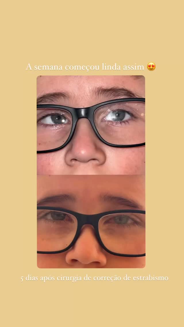 Entre o antes e o depois existem histórias de coragem. Olhos que se alinham, vidas que se transformam, sorrisos que voltam sem medo.
Não é só sobre enxergar melhor — é sobre se reconhecer no espelho e sustentar o próprio olhar.
Revi cada imagem neste Carnaval… e em cada uma delas, um recomeço.