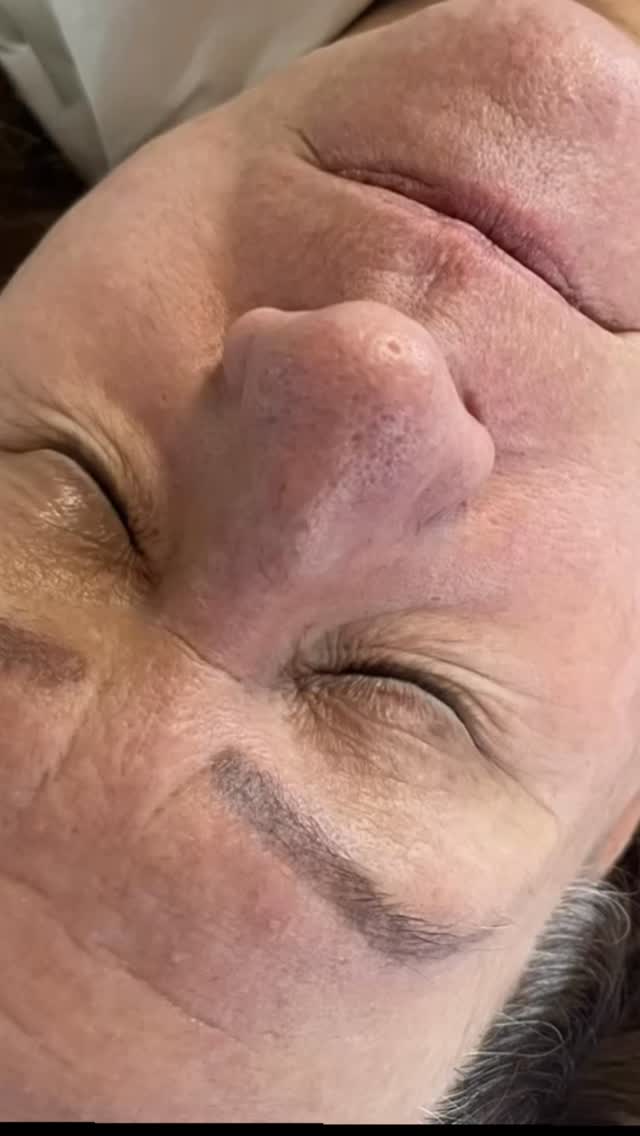 The simple treatment that gives your skin life . The best anti aging treatment when talking about retraining and rebooting collagen out there!!
The results peak at around 6 weeks !
BUT THIS IS NOT A ONE TIME MIRACLE TREATMENT. The skin and inflammatory response needs safety triggering so consistently is key 🔑
I am loving these results for my client 👌🏼
Building skin takes a systematic approach. Carefully selected treatments are part of a long term plan to help build your skin from the bottom to the top.
A boujee hotel will collapse if the foundations can’t kept it up!
Progressive skin rejuvenation is my jam.
I am not afraid to post raw unfiltered close ups of my clients skin improvements because I trust the foundational approach which have been winning for decades. Forget the fads 🫣
When you understand skin treatments work ( with client commitment too)
Interested to know more about collagen, lifting and rejuvenate microneedling ? DM or comment “ glow”
Anna ❤️
#leightonbuzzardaesthetics #leightonbuzzardlocal #leightonbuzzardmums #leightonbuzzardskinclinic #microneedling