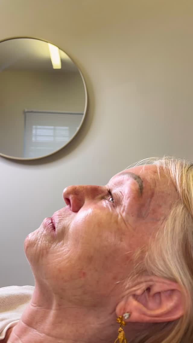 NON SURGICAL RHINOPLASTY 👃🏼
Our client wasn’t aware that dermal filler can be used to straighten and balance the nose without surgery.
Using carefully placed filler, we were able to smooth the bridge, improve overall symmetry and subtly lift the nasal tip, creating a more balanced side profile while maintaining natural results.
Non-surgical rhinoplasty is ideal for those looking to improve the appearance of the nose without surgery or downtime.
——
#nonsurgicalnosejob #scunthorpeaesthetics #dermalfiller #lincolnshireaesthetics #nurse