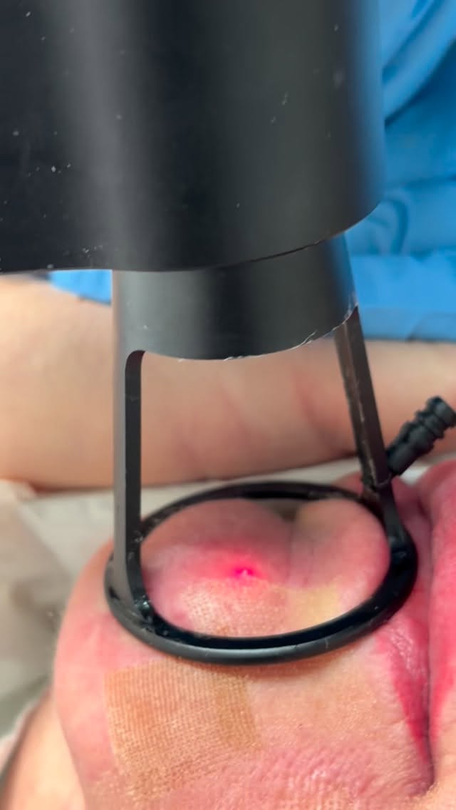 Co2 laser working its magic to resurface the skin 🪄✨ #co2laser #co2laserderby #skinresurfacing #skinrejuvenation #skinresurfacinglaser