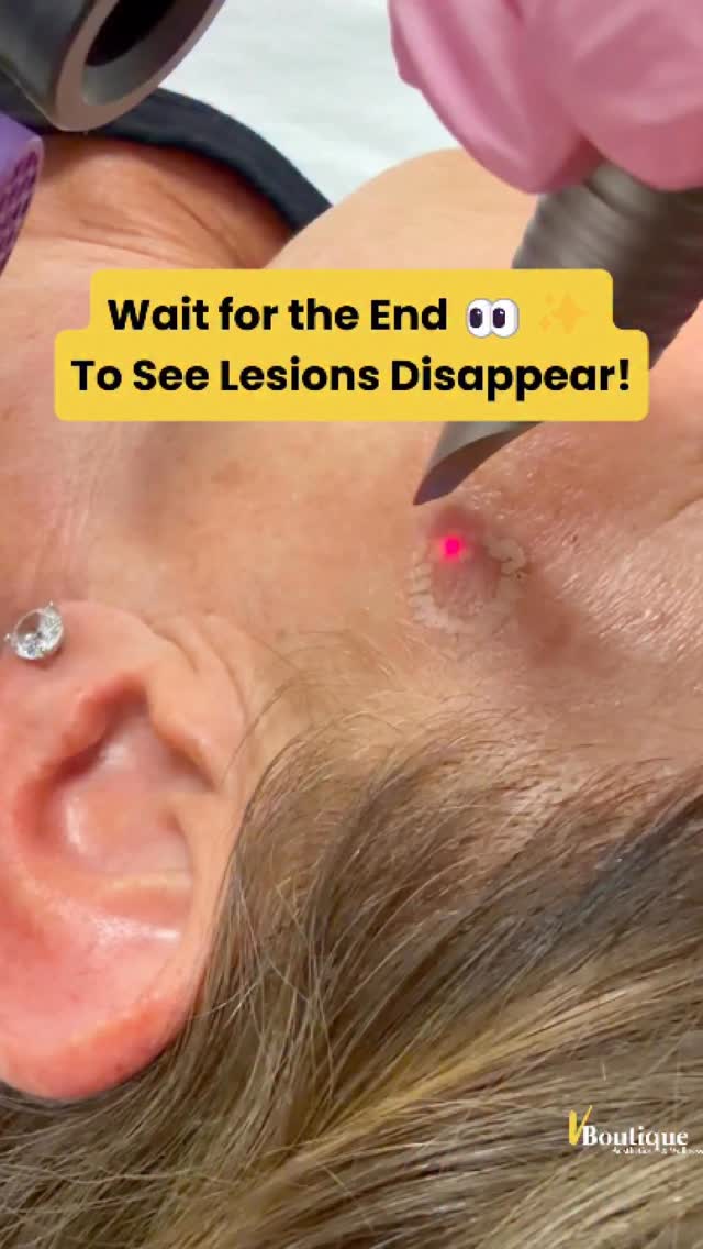 ✨ LASER LESION REMOVAL + FULL FACE RESURFACING ✨
🔹 Step 1: Carefully removing slightly raised or textured dark lesions (after confirming they are benign) using a gentle full-field Erbium laser beam.
This often requires multiple precise passes — the key is removing the lesion while protecting the surrounding skin to avoid excess inflammation, hyperpigmentation, or unnecessary downtime.
🔹 Step 2: Fractional resurfacing of the entire face.
We customize the depth, density, and energy based on your skin condition, goals, and how much downtime you can tolerate.🤕
⏳ Downtime ranges from:
• A few days of redness + light peeling
• Up to about a week of swelling, redness, and peeling
✨ Results?
• Fresher, glowing skin
• Softening of fine lines + wrinkles
• Collagen & elastin stimulation
• Subtle skin tightening
With topical numbing, this treatment is surprisingly comfortable 💆🏻♀️
This time of year is ideal ☀️ — when sun exposure is lower and patients want luminous, rejuvenated skin heading into summer.
We enhance healing and results with PRP or exosomes post-treatment, along with customized skincare to optimize recovery and collagen remodeling.🌟
⚠️ These are advanced laser procedures and should always be performed by experienced providers who understand skin biology, laser physics, and pigmentation risk.
#LaserResurfacing #ErbiumLaser #SkinRejuvenation #fotona #AdvancedAesthetics