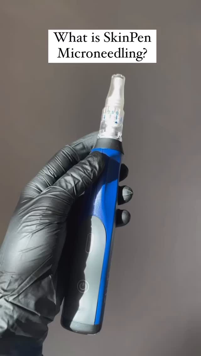 Did you know from the age of 20 we lose 1% of our collagen a year… which is why microneedling is your answer to bank collagen since 3 sessions increases collagen production by 400%!!!
SkinPen Microneedling stimulates your skin’s natural healing process to smooth texture, soften fine lines, and refresh your glow - with little downtime and real results.
FDA approved medical grade device !
Why SkinPen Microneedling?
✨Boosts collagen + elastin
✨Stimulates collagen production
✨Improves skin tone + texture
✨Reduces fine lines and wrinkles
✨Diminishes acne scars and pores
✨Gives a natural radiant glow ⭐️🌟⭐️
📍London Road Clinic: 65 London Road, Newark NG24 1RZ
📞 01636 680767
📧 hello@londonroadclinic.com
🔗 Booking link in bio