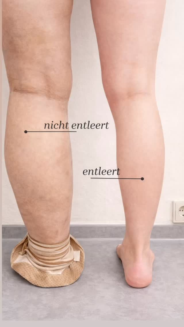 Schwere Beine, Spannungsgefühl oder sichtbare Schwellungen?
Du musst dich damit nicht abfinden. Wenn dein Körper Wasser einlagert oder deine Beine sich ständig „voll“ anfühlen, kann gezielte Unterstützung wie die Maderotherapie helfen, dein Lymphsystem zu aktivieren und dein Wohlbefinden spürbar zu verbessern.
✨ Fühl dich wieder leichter.
✨ Fühl dich wieder wohl in deiner Haut.
Buche jetzt deinen Termin und starte in ein neues Körpergefühl
💛
#maderotherapie #lipödem #lymphödem #lymphaticmassage #lymphdrainage