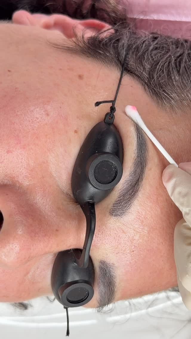 💁♀️After 3-4 annual touch up! This is what you should do to lighten up and get fresh new brows ❤️❤️❤️
#tattooedbrowremoval #lasertattooremoval #wellingtontattooremoval #fabulashbrows #judynguyen