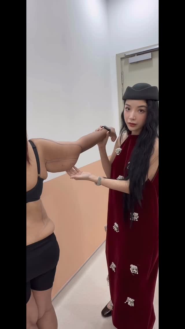 Arm liposuction + lifting Arm .
Arm liposuction removes excess fat to slim and contour the upper arms, while arm lifting (brachioplasty) removes loose, sagging skin to create a firmer, more toned arm shape.
This combination is ideal for patients who have both excess fat and loose skin in the upper arm area.
#armlifting #armlposuction
#lipo #lipo360 #lipo360bbl