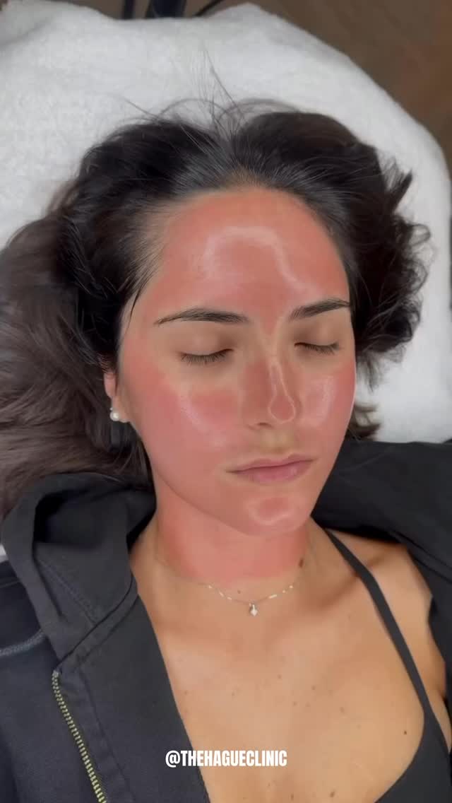 SkinPen is de crème de la crème van microneedling 🤌
#microneedlingnederland #skinpennederland #skinpendenhaag #microneedlingdenhaag #zalmdna