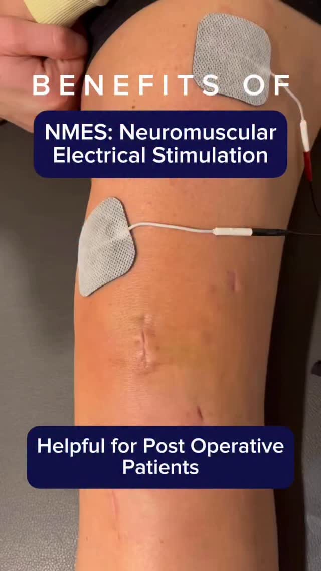 NMES is a powerful post-surgery rehab tool ⚡️
It helps activate weak muscles, build strength, prevent muscle loss, and retrain movement when muscles won’t fire properly.
Commonly used after ACL reconstruction, meniscus repair, and total knee replacements. 🦵
#compasspt #physicaltherapy #NMES #aclrecovery