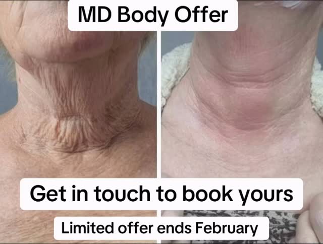 I have a time limited, space limited offer on the Million Dollar Body treatment 💗
Ready to feel firmer, smoother and summer‑ready from head to toe? These results are from fellow Million Dollar Technicians… and now I’m opening up exclusive spaces to build my own Million Dollar Body portfolio.
For Feb bookings only, I’m offering:
🔥 35% off a full Million Dollar Body course
🔥 £52 per treatment instead of £80
🔥 6‑month transformation plan (one treatment per month)
To access this offer, you’ll:
📸 Agree to let me capture and share your progress
📅 Commit to the full 6‑treatment programme
✨ Be suitable for microneedling treatments
🌟 Be ready for a real, visible body glow‑up
Spaces are limited so I can give each client proper attention and to access the offer you must have booked by the end of February 💗
If you want to start your summer body now, drop me a message and I’ll get you booked in.
Offer available for Body treatments only
#skintightening #fyp #selfcare #glowup #cambridgeshire