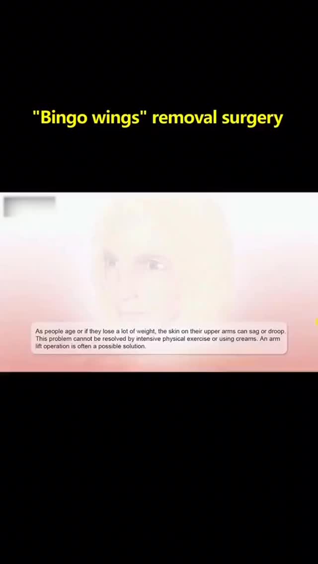 How is the arm liposuction + lifting arm doing . Let Whatch until the end
#armliposuction #liftingarm #liposucción #lipo360