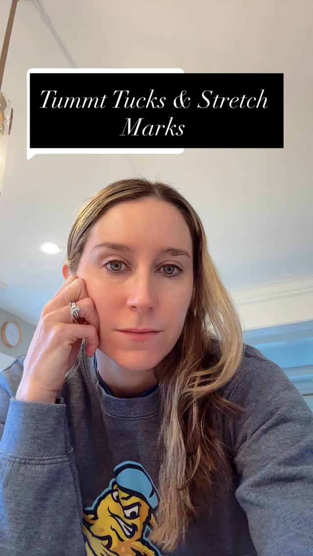 Tummy Tucks & Stretch Marks 👇
A few thoughts—
General rule of thumb is stretch marks that are above the belly button generally will still be present after a tummy tuck. However, because the skin will move downwards on the abdomen, as it is tightened, the stretch marks will be in a much less visible position in the lower abdomen.
stretch marks tend to be more visible with the loose creepy skin that is present prior to a tummy tuck. Once the skin is tightened, the stretch marks tend to be less visible.
if we are performing a Fleur de Lis tummy tuck, which involves a horizontal and vertical incision, stretch marks on the central abdominal region have a better chance of being completely excised during surgery.
If you have questions about plastic surgery topics, drop them in the comments below⬇️
⌨️ www.drmeganmd.com ☎️206.860.5582 📍 Downtown Seattle, Washington
#tummytuck #stretchmarks #seattleplasticsurgery #questionsandanswers #femaleplasticsurgeon