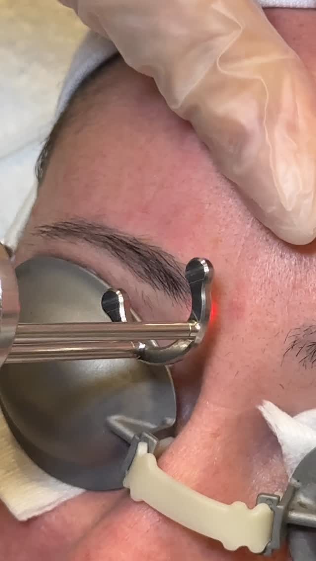 Permanent makeup isnโt truly โpermanentโ in colour โ it changes over time.
As brow pigment sits in the skin for years, your body slowly breaks it down. Certain colour molecules fade faster than others, which can leave behind unwanted tones like red, orange, grey, or even blue. Sun exposure, skin type, depth of implantation, and the original pigment formula all play a role in how brows age.
If your brows no longer match your skin tone or hair colour, laser removal can safely lift the old pigment so you can start fresh with a softer, more natural result.
Book your laser treatment online or call 780-777-2792๐ฒ
#yeglaser #yegtattooremoval #pmuremoval #yegpmuremoval