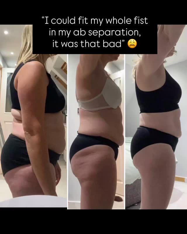 From a whole fist to hard abs? 👏
There’s only one solution: rebuild your core 💛
Genna started her core journey with me feeling overwhelmed about her tummy, her ab separation, doing cardio, working full time, studying, mum of 3, and hoping for change but not moving forward 😢
And how could you? Without the right exercise and support / understanding!?
‘Life is hectic. I hate my tummy, it overhangs. I have 3 kids of 19, 16 and 9 years old. My Dr said I have ab separation (still). So now it’s time to change: can you help?’
Yes I’d love to !! ❤️ I’ll break it down into simple, structured, short workouts which WORK and SUPPORT 💁♀️
3 months on 👀👆
1️⃣ Genna joined my 4 week Beginner’s Core Builder program, learning to connect with her deep core and strengthening from the inside out 🫶
2️⃣ This determined mama progressed onto my Intermediate program to build on her strength + momentum, + got more REAL results on the OUTSIDE … as well as the inside 🔥
3️⃣ By this time, lost most of you 🤣, you don’t want to leave the app 😍!! Genna did my Intermediate Plus - something you can do as a follow on, loyalty core program…
The overwhelmed mum of 3 has transformed her body, healed her core (and her last pregnancy was 10 years ago 🥲) and enjoyed it 😅🙏
I LOVE having you in the app Genna 💖🎉 (& k have a feeling you’ll be joining my brand new ADVANCED core builder tomorrow 🤔 - what a turnaround 🔥
The MARCH CORE BUILDER programs are coming 👀
Sign ups open at 7am tomorrow (23rd Feb)
Spaces are limited (& this is hugely in demand 🚀!)
Head to the link in my bio for info + the link to join.
Or pop me a DM & I’ll send it over.
Can’t wait to support you ! 💖
#motherhoodjourney #katesmumfitclub #corestrengthening #coreexercises #abdominalseparation