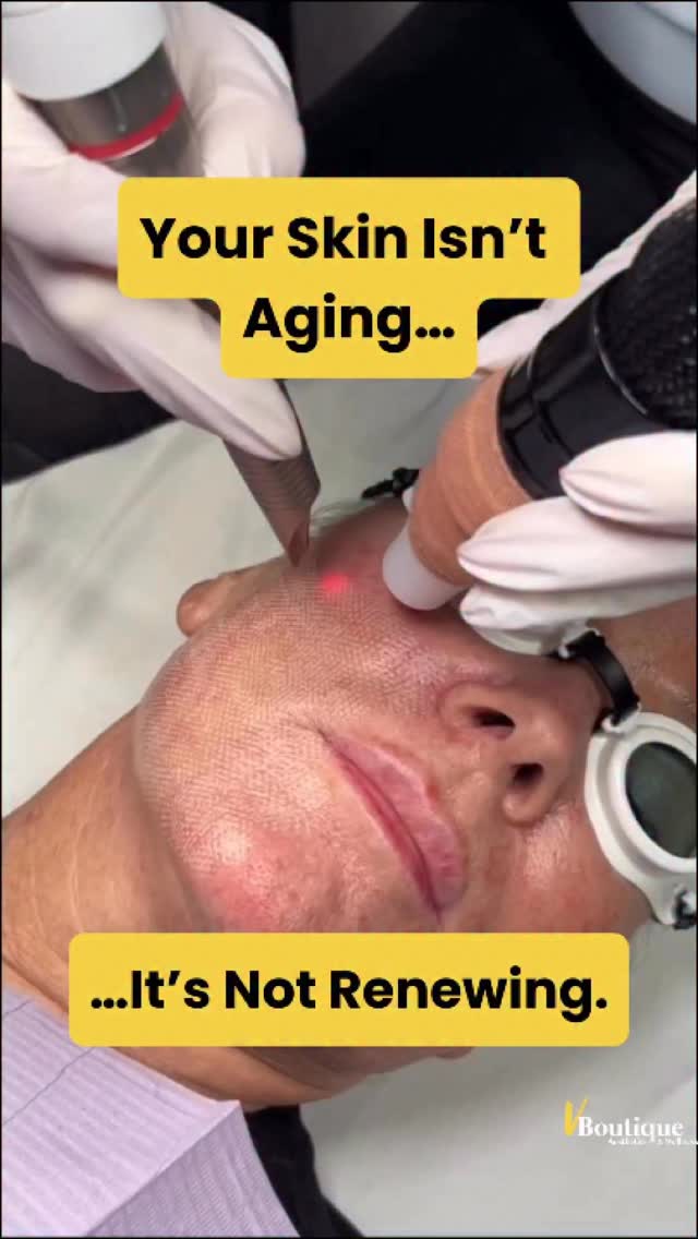 ✨ Why Laser Peels Work So Well
As we age, our skin renewal slows dramatically.
In our 20s our skin turns over every ~28 days…
Later it can take 45–60+ days.
That means dead skin, sun damage, pigment and rough texture stay on the surface much longer.
Laser peels allow us to precisely remove those damaged layers and stimulate new healthy skin.
Benefits include:
✨ Brighter tone
✨ Smoother texture
✨ Reduction in sun damage & dark spots
✨ Treatment of benign and precancerous lesions
✨ Collagen stimulation for firmer skin
Downtime can be 1–2 days or up to a week depending on the intensity of treatment.
We often combine treatments with:
🧬 PRP
🧫 Exosomes
🧴 Medical-grade skincare
And because every face is different, we use multiple laser technologies to customize treatments safely for every skin type.
Healthy skin is not about chasing trends — it’s about precision treatments.
#LaserSkin
#SkinRenewal
#LaserDermatology
#AgeBetter
#SkinRejuvenation