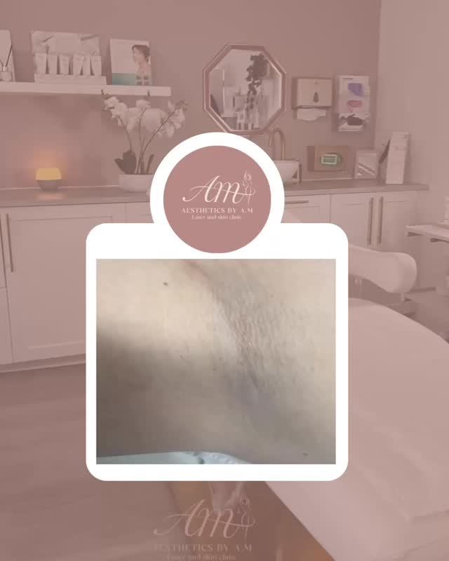 Who is ready to get results like this? This client came for her annual top up and this is the amount of hair she got in one year 🥰 #aestheticsbyam #oxfordsalon #oxfordaestheticclinic #oxforduniversity