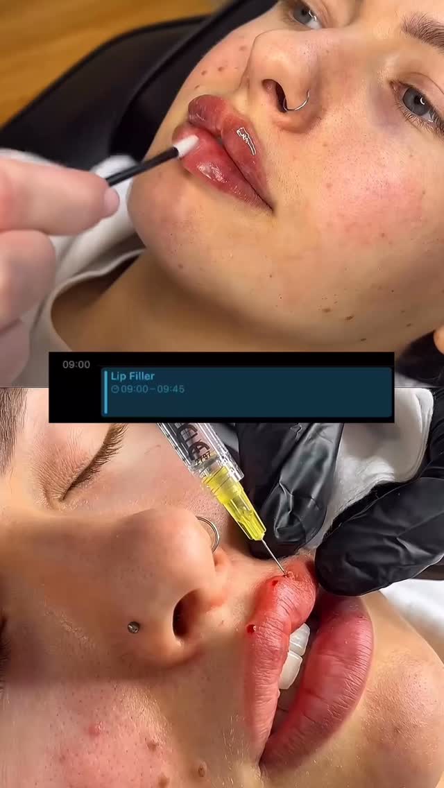 POV: you spend a day with an aesthetic practitioner 💉✨
Subtle enhancements. Elevated confidence.
TW: Blood & Needles❗️
#aesthetics #aestheticsclinic #aestheticspractitioner #profilebalancing #lipfiller #chinfiller #cheekfiller #polynucleotides #sunderlandaesthetics #aestheticssunderland #sunderlandaestheticsclinic