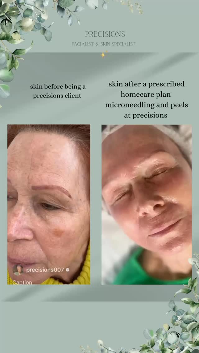 Progress is the ultimate sign that the trust put in me is paying off.
This client came to me wanting to address multiple skin concerns including aging skin, dehydration, pigmentation and fine lines and wrinkles .
Through careful skin analysis, methodical in clinic treatments and a super boosting home care commitment using our chosen @noon_aesthetics.uk these incredible results have been achieved. ✨🙌🏻
This wasn’t a guessing game, the decisions and protocols I have carried out were based on a solid knowledge of skin, pathological, biological and ingredient knowledge.
I am all about long term skin health.
What did this client get for her investment ?
Reduced lines and wrinkles, plumper, stronger , hydrated, reduced appearance of sun damage and more. Younger looking skin, confidence and more ❤️
If your looking for results with science backed products, with a holistic twist to calm the nervous system , I AM THAT WOMEN 👌🏼
DM to connect
Anna ❤️
#leightonbuzzard #leightonbuzzardmums #bedfordshireskinclinic #clearskin #pigmentationtreatment
